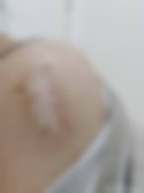 去除疤痕用什么药之维生素类