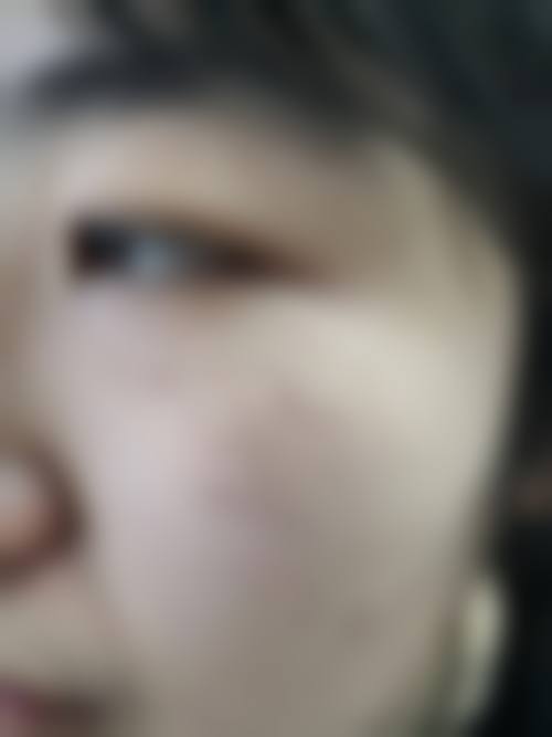 七、昆山虹桥医院祛痣的费用高值得吗?