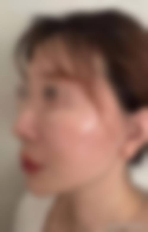 选择苹果肌复位术的注意事项