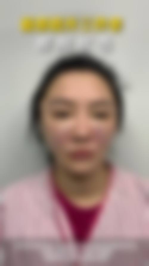 请问做苹果肌复位术需要多少钱？成都张艳峰医生技术优，苹果肌复位1.6万起，效果超自然！ 