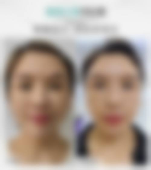韩国大拉皮手术排名医生推荐：黄寅守、金宪俊、郑在皓，技术精湛术后效果自然！ 
