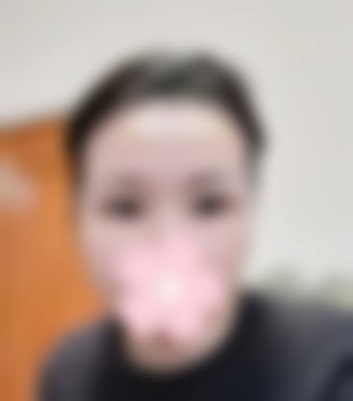 常见的割双眼皮后遗症