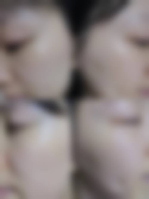 超皮秒术后冷敷注意事项
