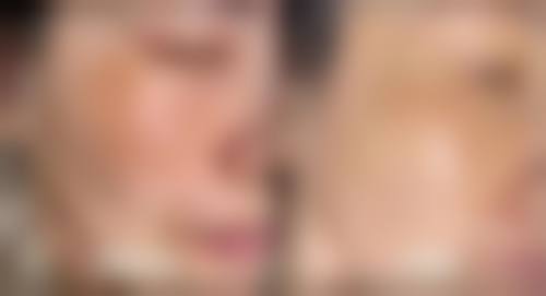 超皮秒术后避免阳光直射注意事项
