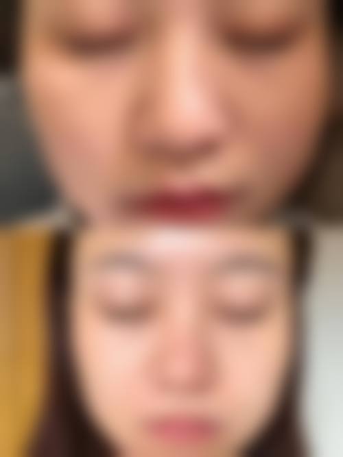 超皮秒术后保持良好生活习惯注意事项