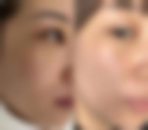 超皮秒术后补水注意事项