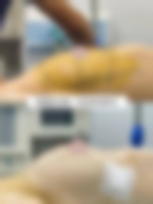 玻尿酸品质与隆胸填充保持时间的关系