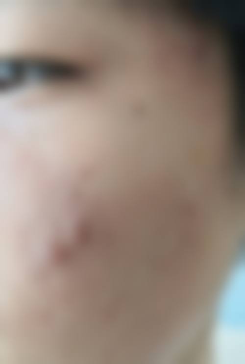 徐州美玲医疗美容治疗反馈与口碑评价。