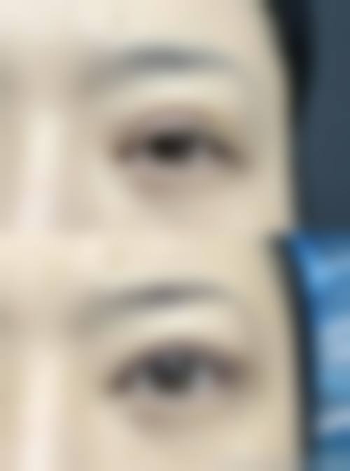 福田庆三医生双眼皮隆鼻技术优势