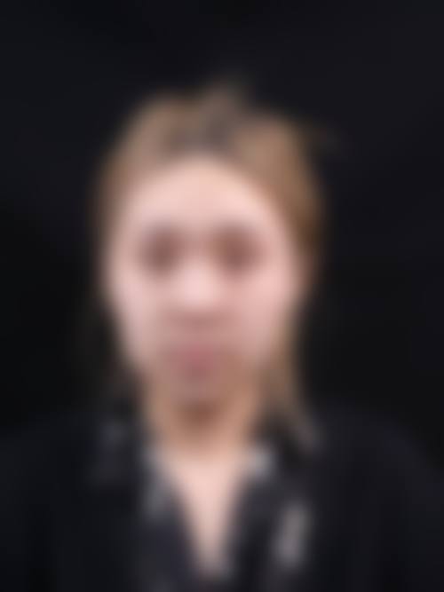 珠海仁瑞医疗整形美容门诊部，张煜院长鼻综合+鼻修复技术超靠谱值得选！多材料雕琢美鼻，术后效果立体自然！ 