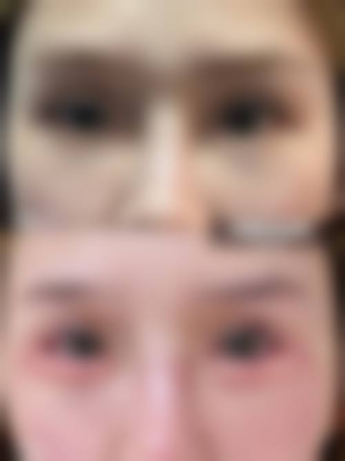 双眼皮变形治疗的注意事项