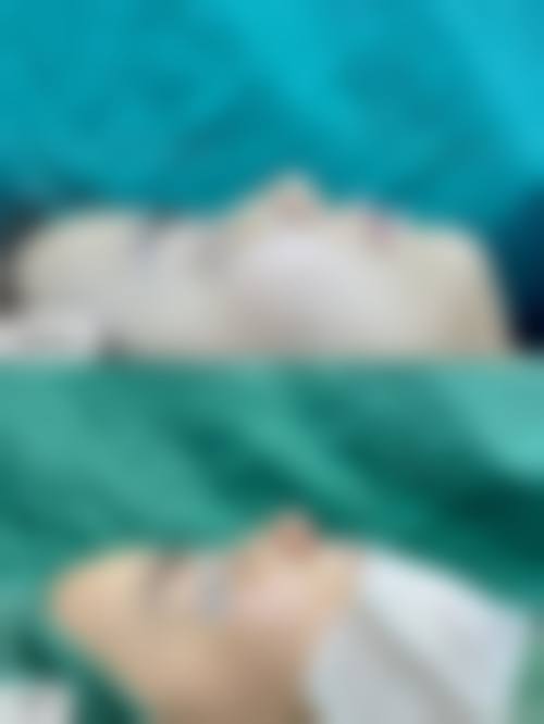 七、雷中元医生的自体软骨隆鼻手术有哪些优势?