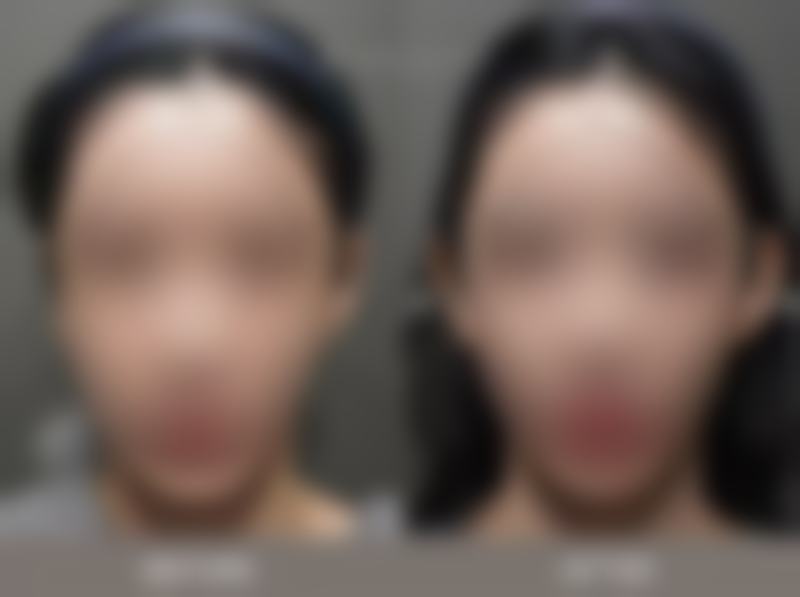 环缩耳术后避免碰撞挤压