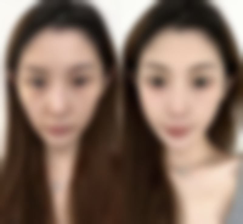 张立天在成都哪家医院坐诊？成都东篱医院，四级资质，下颌角截骨3.8万起！ 