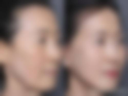 微拉美面部提升：改善多种面部老化问题