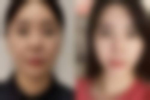 李衍江院长：微拉美面部提升的不错技艺