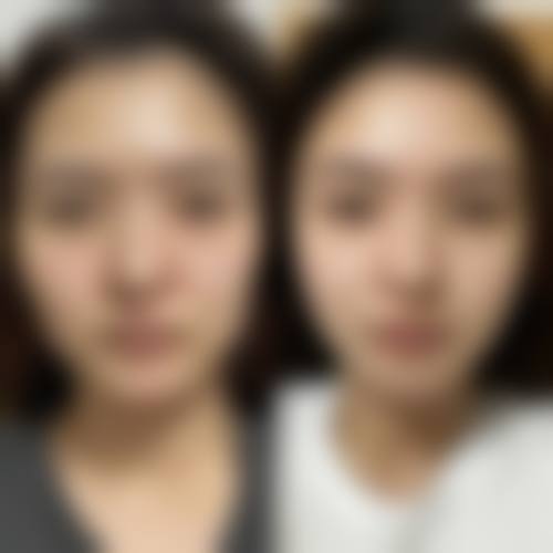沈阳百嘉丽医院李衍江微拉美面部提升：深层抗衰长效紧致