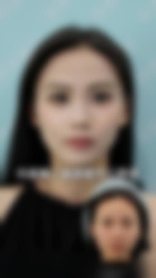 深圳拉皮手术的价格及注意事项