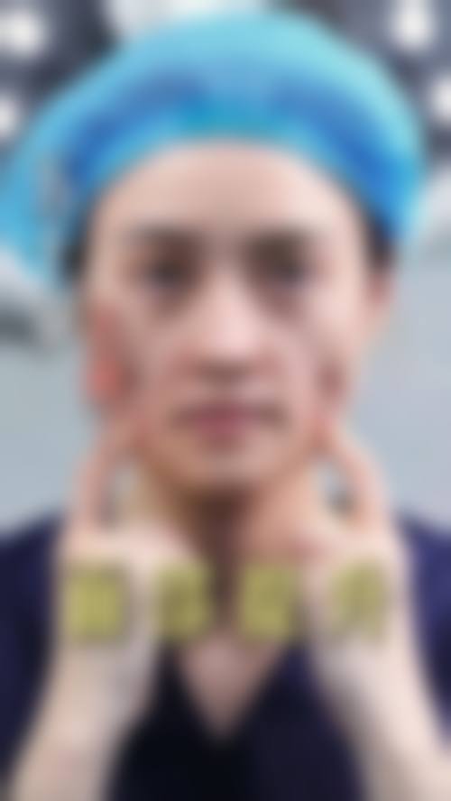 袁强博士拉皮手术的技术优势