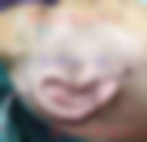 小耳术后额外费用及注意事项