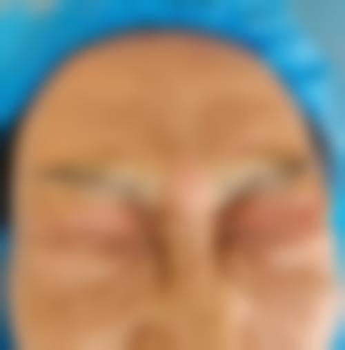 除皱针提升面部轮廓