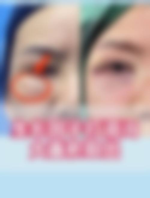 王绍国取生长因子好吗？20年经验+独创技术，高清除率低复发率值得选！ 