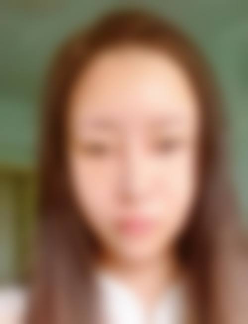 潮州博兰雅整形医院治疗反馈与口碑评价。