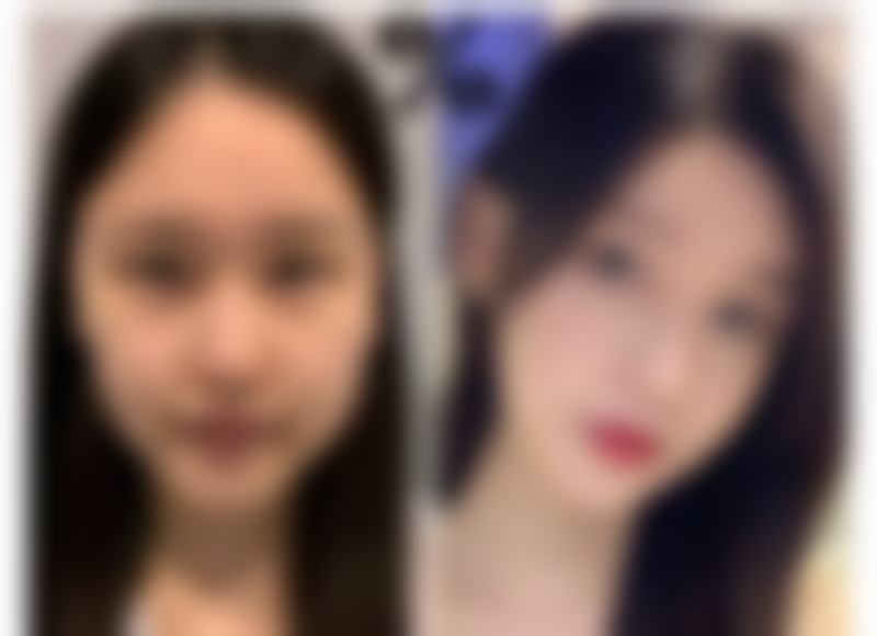 一针降颧骨的技术优势